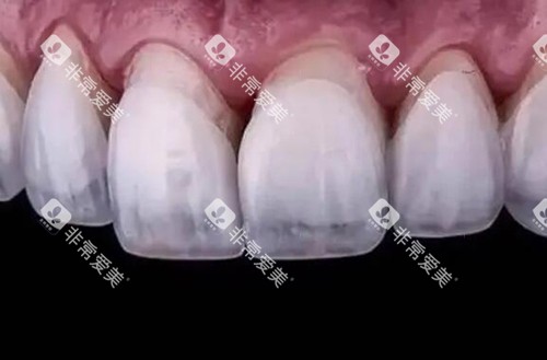 超薄牙贴面照片图 超薄牙贴面照片图
