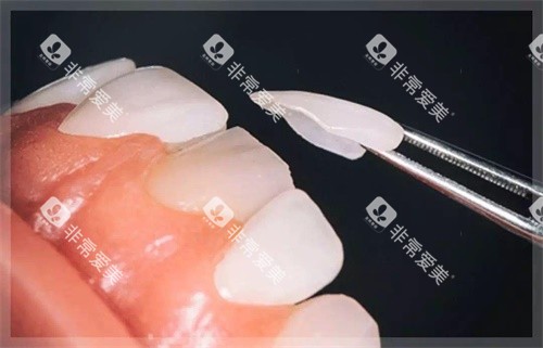 牙贴面图片 牙贴面图片