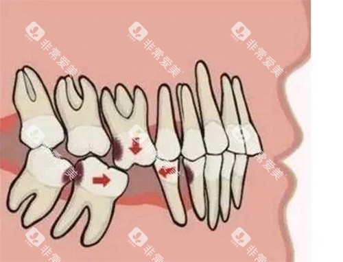 牙齿缺牙照片 牙齿缺牙照片