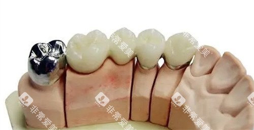 不同种类的烤瓷牙