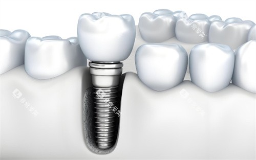 种植牙动画图片展示图 种植牙动画图片展示图