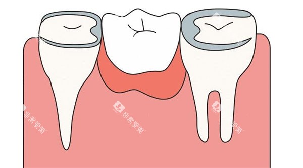 缺牙补牙照片 缺牙补牙照片