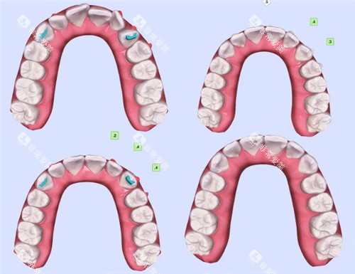 牙齿矫正模拟结果对比 牙齿矫正模拟结果对比
