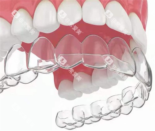 隐形矫正牙齿示意图 隐形矫正牙齿示意图