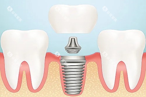 口腔种植牙卡通示意图