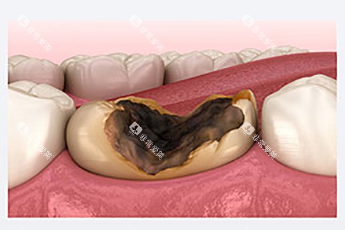 牙齿龋坏图片模型示意图