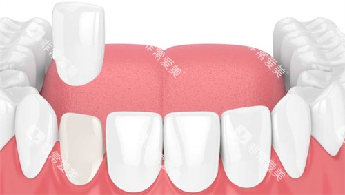 在口腔内进行牙齿贴面