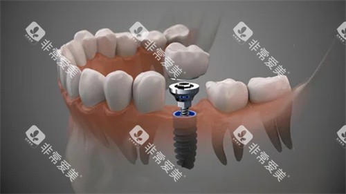 种植牙透视结构图 种植牙透视结构图
