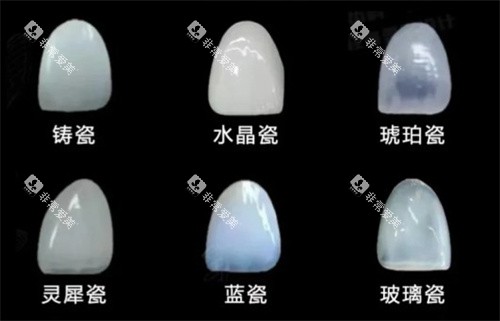 牙贴面材料 牙贴面材料