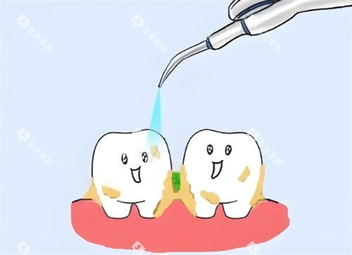洗牙卡通示意图片