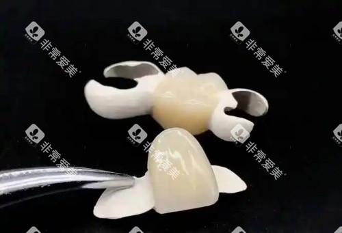 hpp粘接桥牙齿示意图