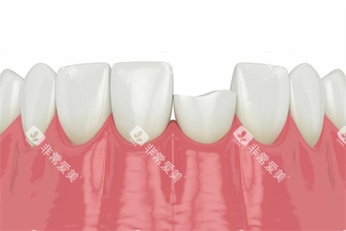 牙齿断裂 牙齿断裂