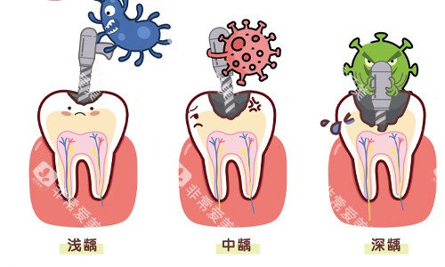 牙齿不同程度龋坏展示 牙齿不同程度龋坏展示