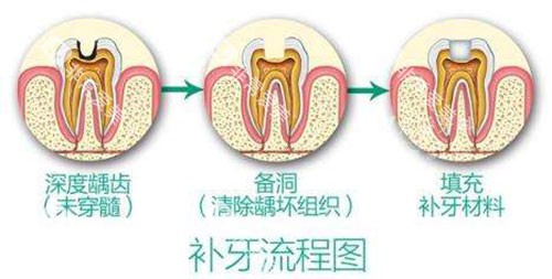 补牙流程图示意图