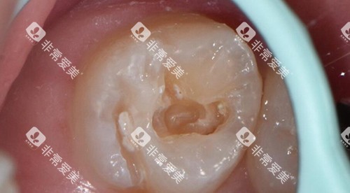 补牙改善图过程