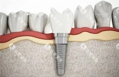 种植牙动画图片