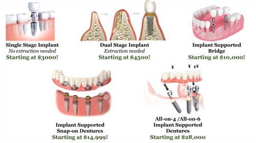 种植牙手术过程图