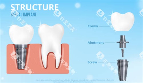 种植牙拆解示意图