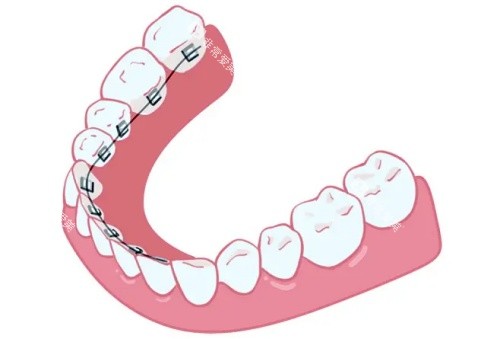 舌侧牙套示意图