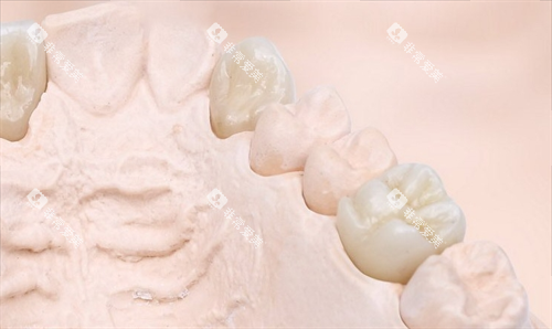 则武全瓷牙模型展示