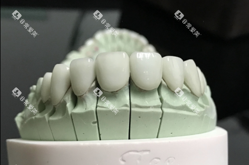 全瓷牙模型展示图