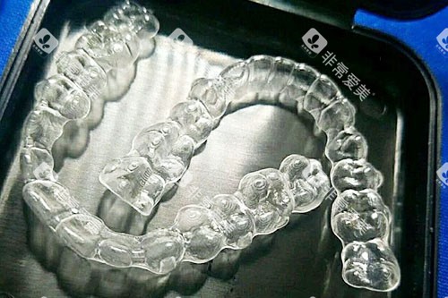 杭州名一口腔牙套实拍图 杭州名一口腔牙套实拍图