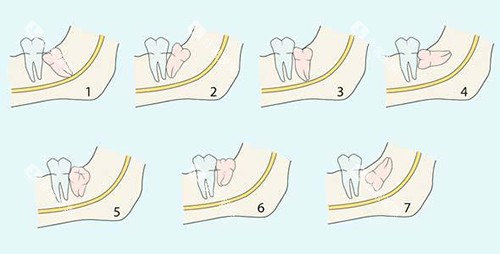 阻生智齿的不同类型