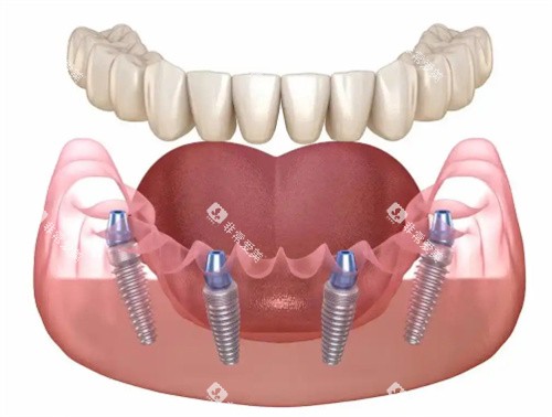 种植牙展示卡通图
