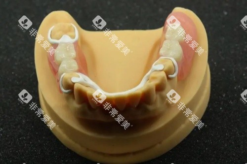 peek义齿支架模型图