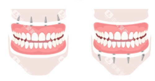 上半口种植牙和下半口种植牙