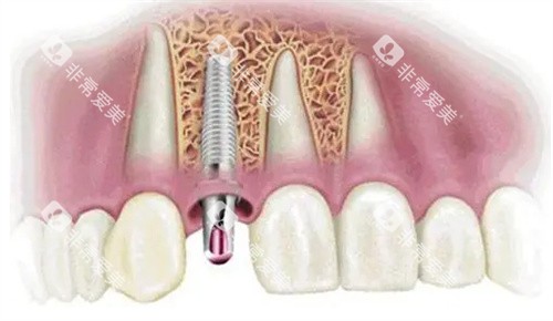 种植牙动画模拟图 种植牙动画模拟图