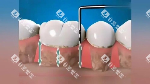 牙周刮治漫画图 牙周刮治漫画图