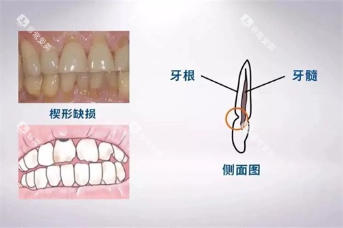 楔状缺损位置示意图 楔状缺损位置示意图