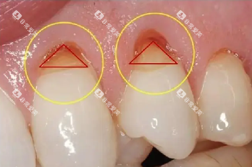 牙齿楔状缺损.webp 牙齿楔状缺损.webp