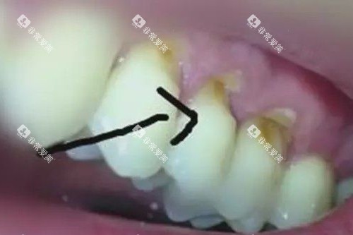 牙齿楔状缺损实拍图 牙齿楔状缺损实拍图