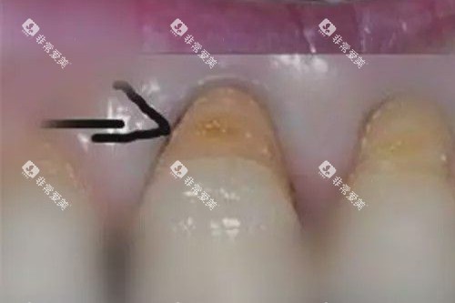 牙齿楔状缺损照片 牙齿楔状缺损照片