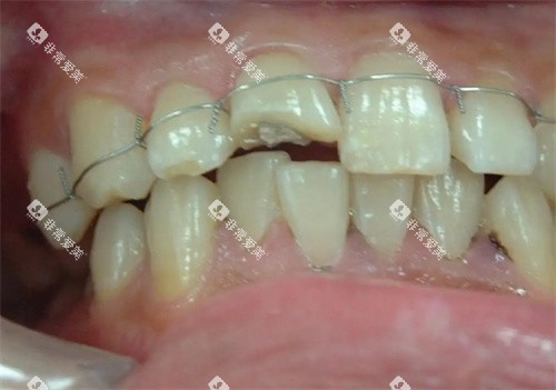 松动牙固定治疗 松动牙固定治疗