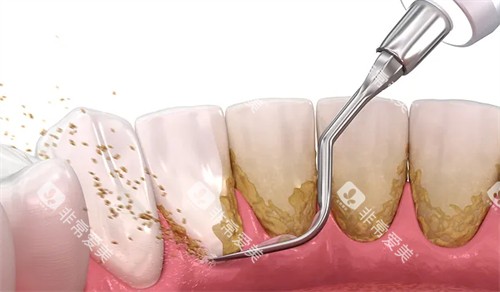 洗牙可改善牙齿污渍 洗牙可改善牙齿污渍