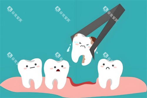 拔牙动画示图 拔牙动画示图