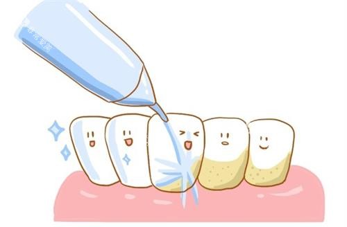 洗牙的示意图 洗牙的示意图