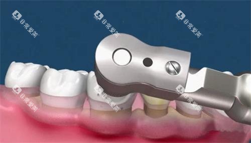 抛光洗牙 抛光洗牙