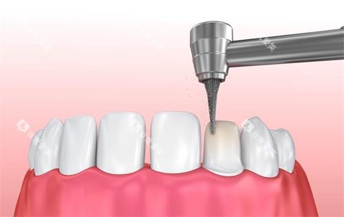 喷砂洗牙 喷砂洗牙