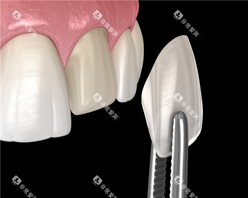 牙齿贴面安装图