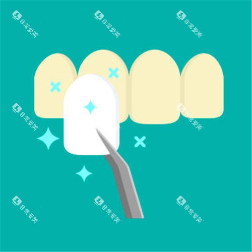 牙齿贴面图 牙齿贴面图