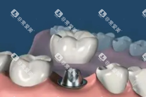 单颗种植牙卡通图片展示 单颗种植牙卡通图片展示