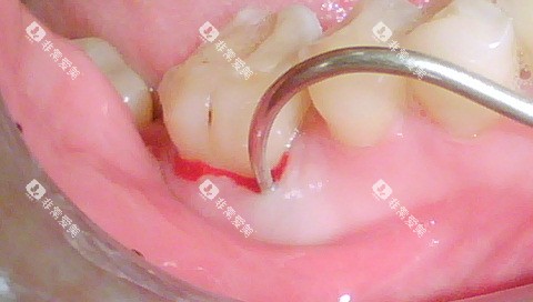 牙周刮治示意图 牙周刮治示意图