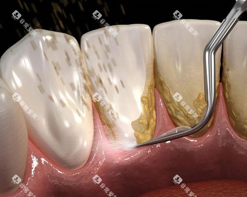 牙周刮治漫画示意图 牙周刮治漫画示意图