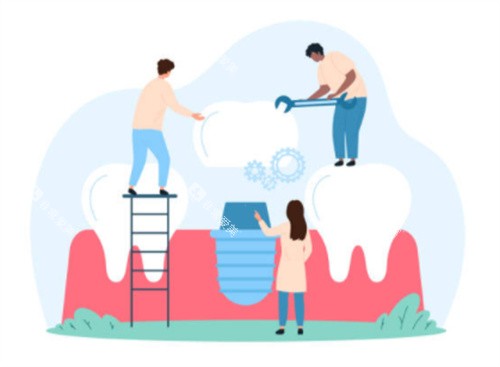 种植牙卡通示意