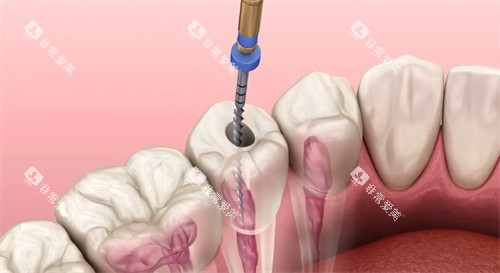 根管治疗动画示意图 根管治疗动画示意图