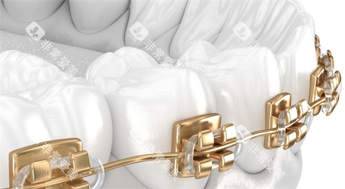 牙套图示 牙套图示